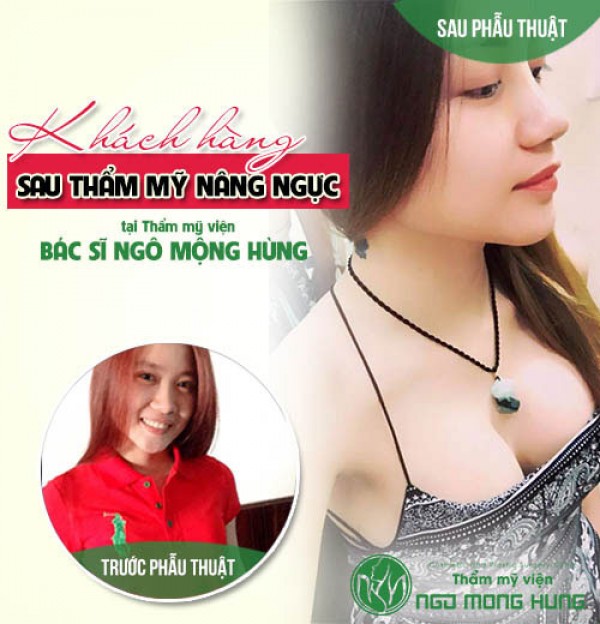 Nâng ngực nội soi đường nách ở đâu uy tín