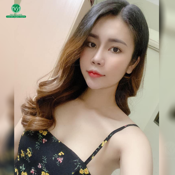 Nâng ngực ở Hà Nội có tốt không