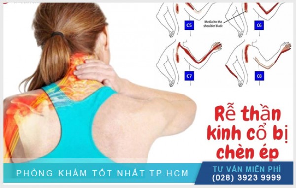 Nguyên nhân chèn ép rễ thần kinh cổ 