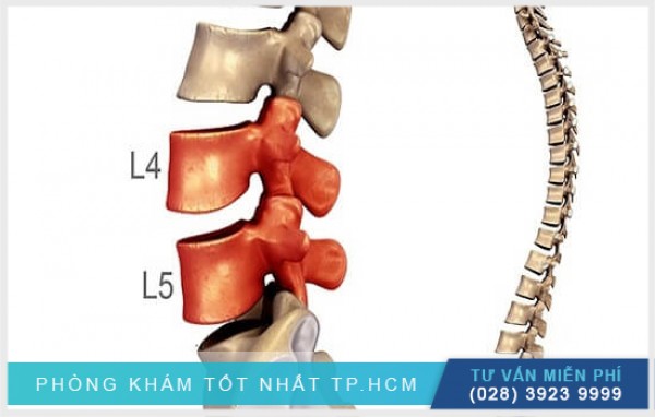 Nguyên nhân dẫn đến thoái hóa đốt sống lưng l4 l5 