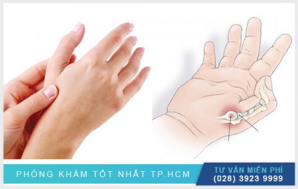 Nguyên nhân đau cổ tay sau sinh 