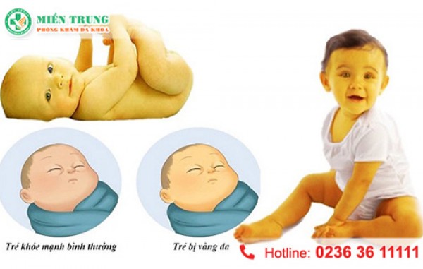 Nguyên nhân vàng da ở trẻ