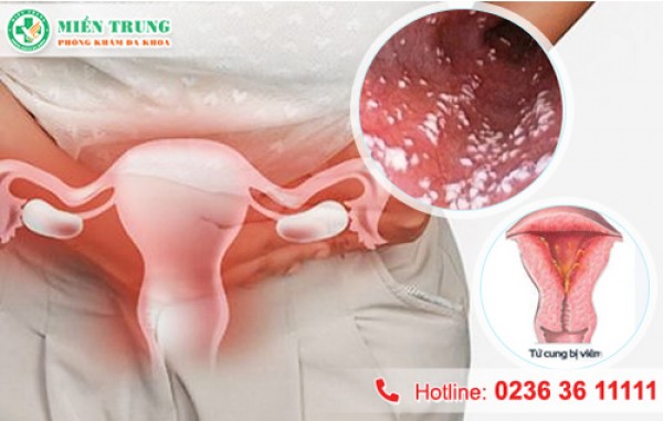 Nguyên nhân viêm nhiễm phụ khoa sau sinh 