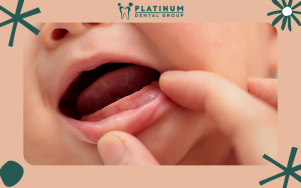 Như thế nào thì được coi là trẻ bị mọc răng chậm? Bạn đã biết chưa?