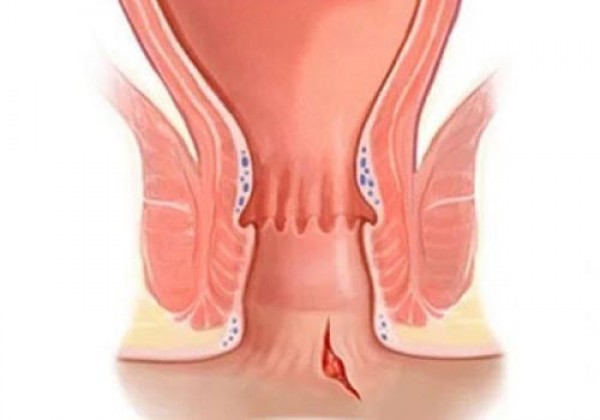 Nứt kẽ hậu môn là gì? Nguyên nhân Dấu hiệu và Cách chữa trị