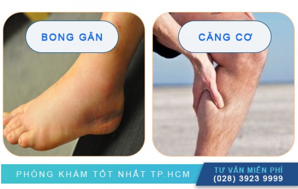 Phân biệt bong gân và căng cơ