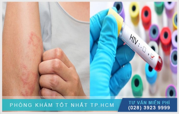 Phát ban hiv có ngứa không