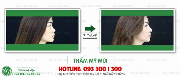 Phẫu thuật nâng mũi ở đâu đẹp nhất sài gòn