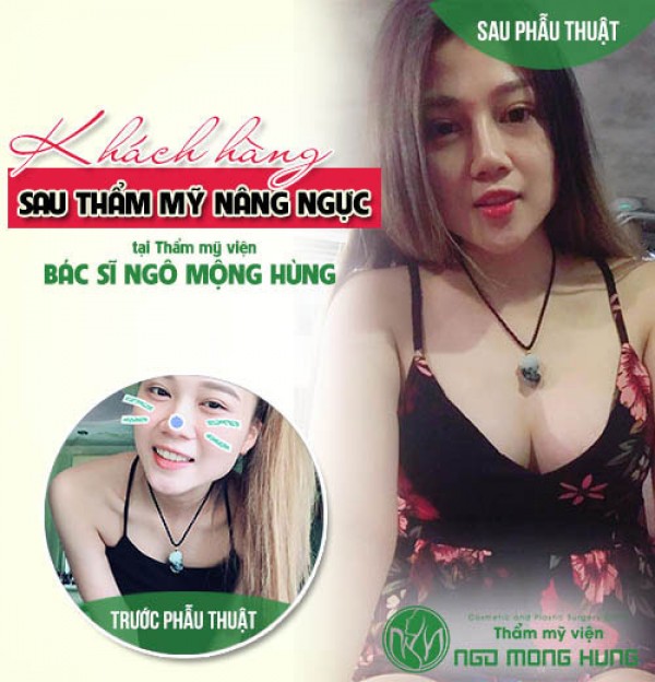 Phẫu thuật nâng ngực bằng phương pháp nội soi