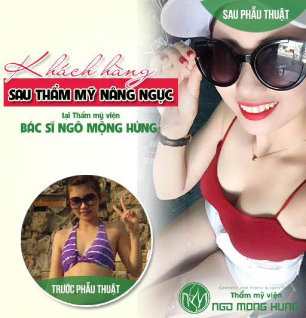 Phẫu thuật nâng ngực có ảnh hưởng đến sức khỏe không