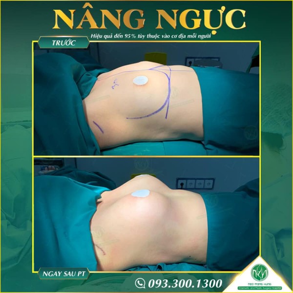 Phẫu thuật nâng ngực nội soi có đau không