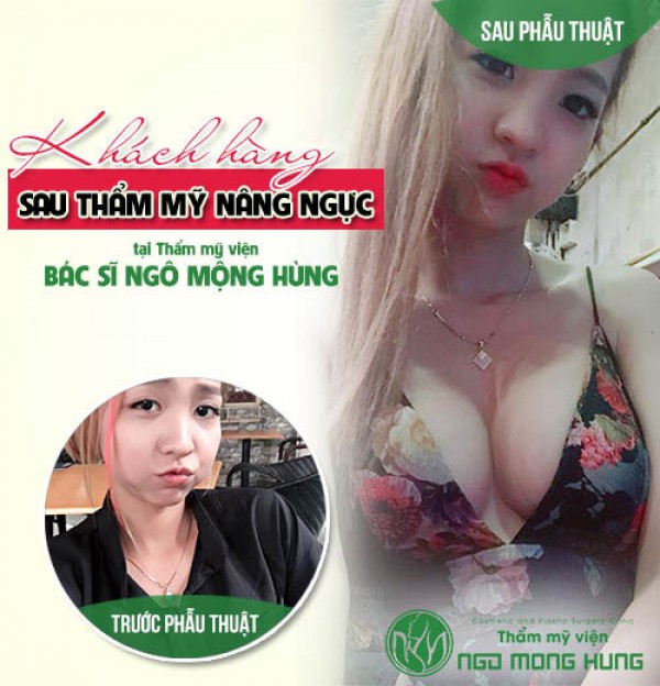 Phẫu thuật nâng ngực uy tín ở đâu