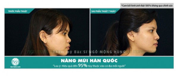 Phẫu thuật thẩm mỹ nâng mũi hếch hết bao nhiêu tiền