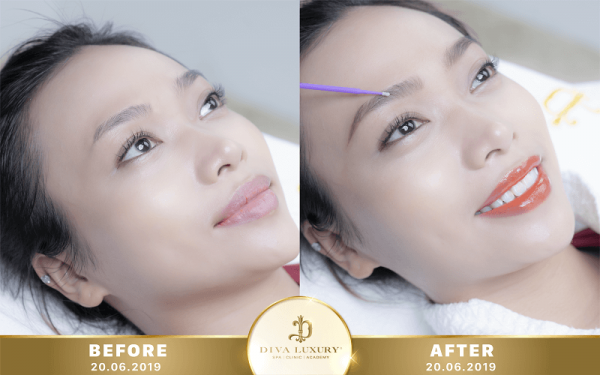 Phun môi collagen là gì? Có nên phun môi collagen màu cam không?