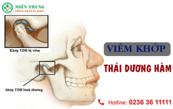Phương pháp điều trị viêm khớp thái dương hiệu quả 