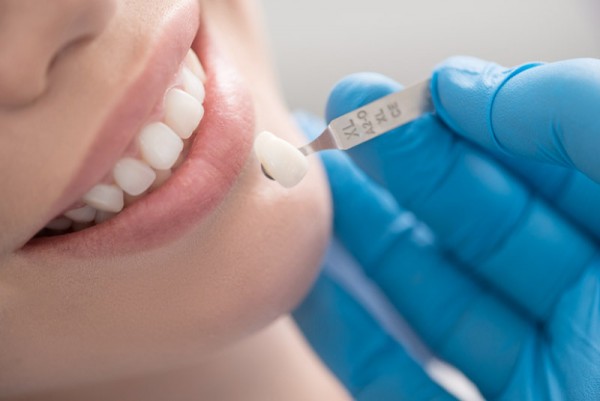 Răng sứ thẩm mỹ là gì? Những điều cần biết trước khi bọc răng sứ (2020)