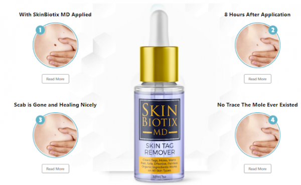 Regain Your Confidence with Skin Biotix MD Skin Tag Remover
