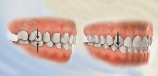 Sai lệch khớp cắn: Nguyên nhân, triệu chứng