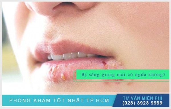 Săng giang mai có ngứa không