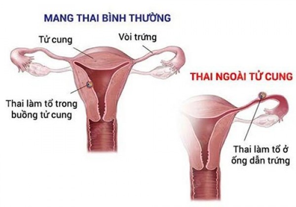 Thai vào tử cung muộn nhất là bao lâu