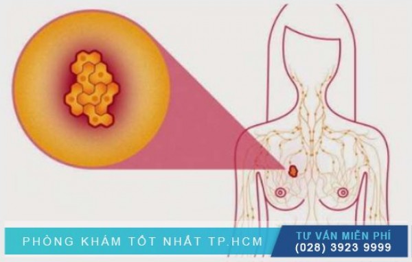 Thay đổi sợi bọc tuyến vú ở phái nữ 