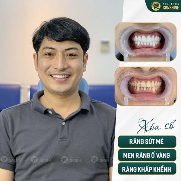 Thời gian bọc răng sứ bao lâu thì ăn được