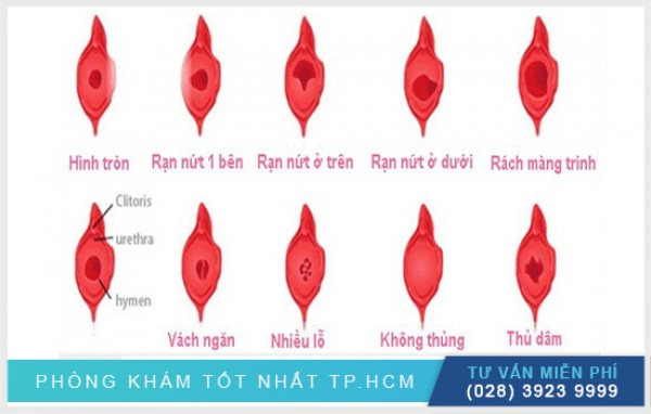 Thông tin về màng trinh 