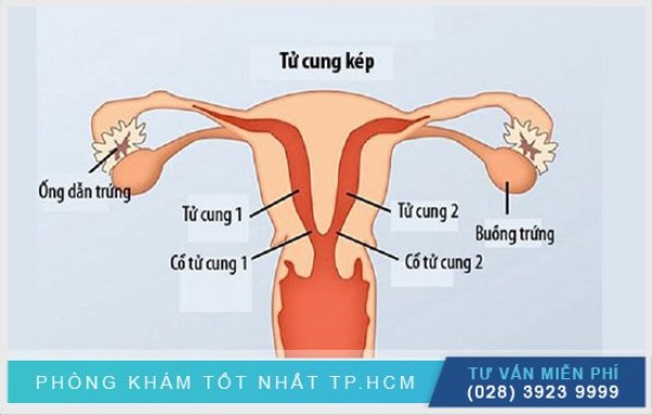 Thông tin về tử cung đôi 