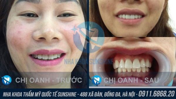 Tìm hiểu bọc răng sứ có đau không?