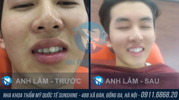 tìm hiểu phủ răng sứ giá bao nhiêu ở Hà Nội