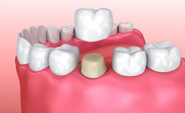 Tìm hiểu răng sứ titan có mấy loại?