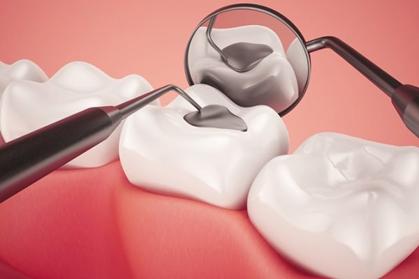 Trám răng và những loại vật liệu dùng để trám răng