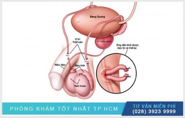 Triệt sản nam tạm thời 