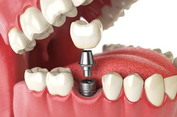 Trồng răng implant tại đà nẵng