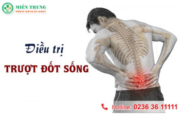 Trượt đốt sống và phương pháp điều trị 
