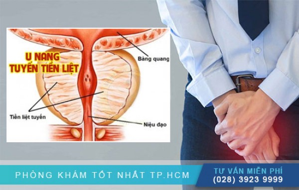 U nang tuyến tiền liệt ở nam giới 