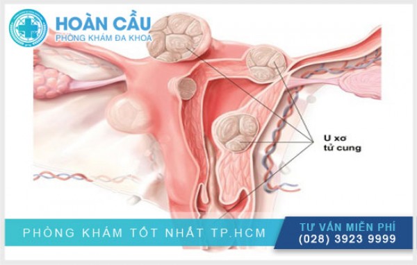 U Xơ Tử Cung Là Gì? Nguyên Nhân Và Cách Điều Trị