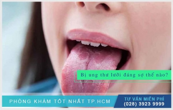 Ung thư lưỡi đáng sợ như thế nào? 