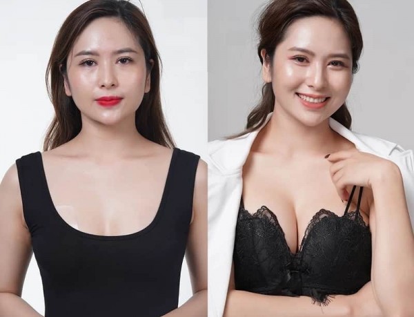 Ưu tiên nâng ngực giá bao nhiêu hay an toàn khi chọn nơi thẩm mỹ