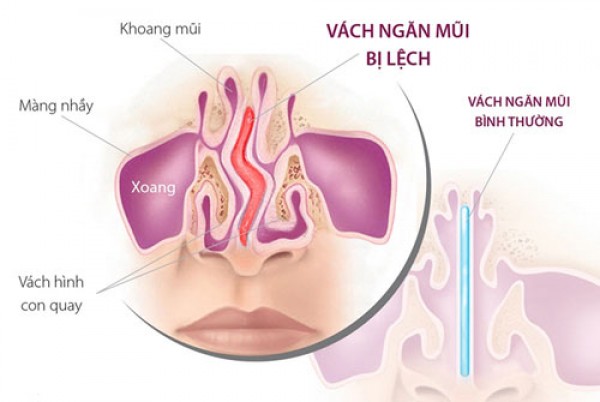  VẸO VÁCH NGĂN MŨI : NGUYÊN NHÂN,TRIỆU CHỨNG VÀ THUỐC ĐIỀU TRỊ