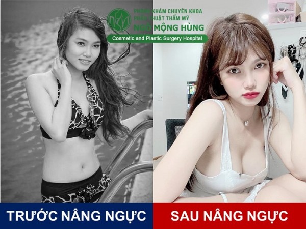 Video phẫu thuật ngực nội soi mới nhất