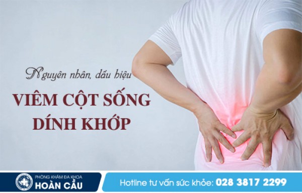 Viêm cột sống dính khớp - Đa khoa Hoàn Cầu 