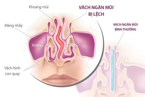 veovachngan